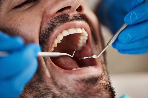 Dental Inlays and Onlays in Magnolia, MS